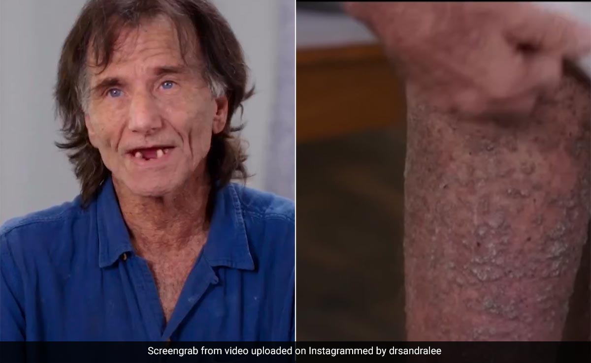 Man With "Crocodile Like Skin" On His Struggle: "Clothes Hurt So Bad"