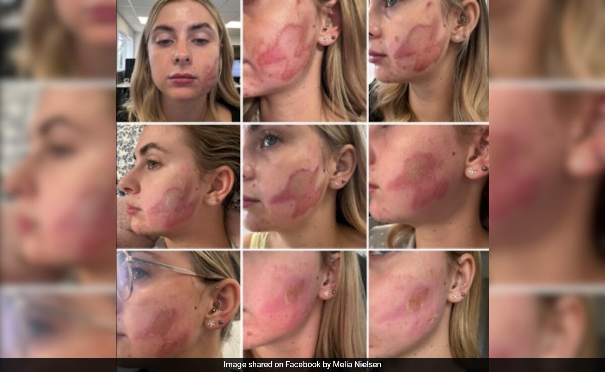 UK Woman Left With Second Degree Burns And Scarring After Microneedling