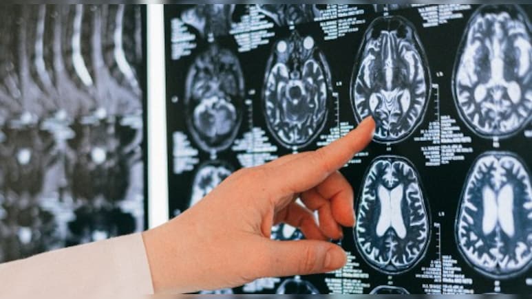 European Watchdog Partially Approves New Alzheimer's Drug