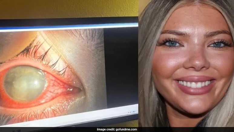 US Woman, 23, Goes Blind In One Eye After Swimming With Contact Lenses