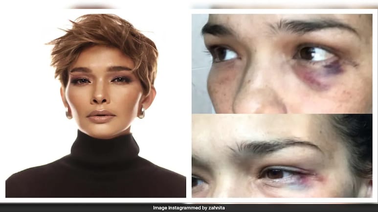 Malaysian Actor Alleges Domestic Abuse By Husband, Pics Show Black Eye