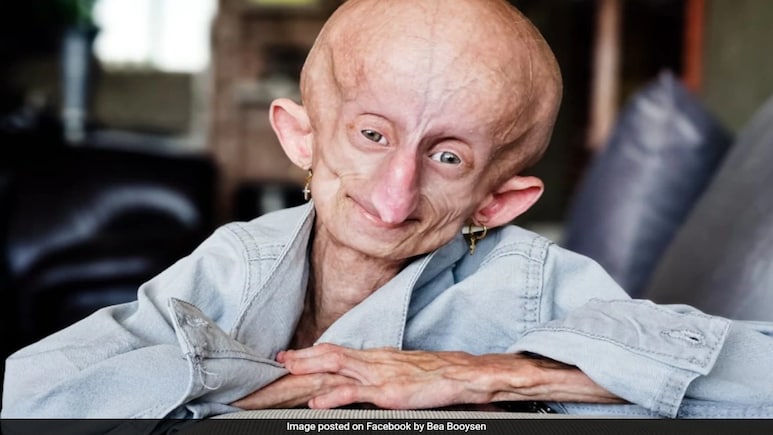 TikTok Star Beandri Booysen Dies At From Rare Aging Disease