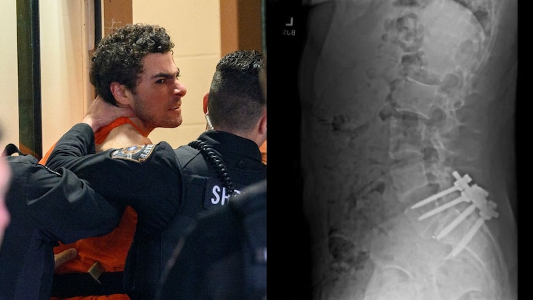 Why Luigi Mangione Killed UnitedHealthcare CEO: A Chronic Back Pain Link